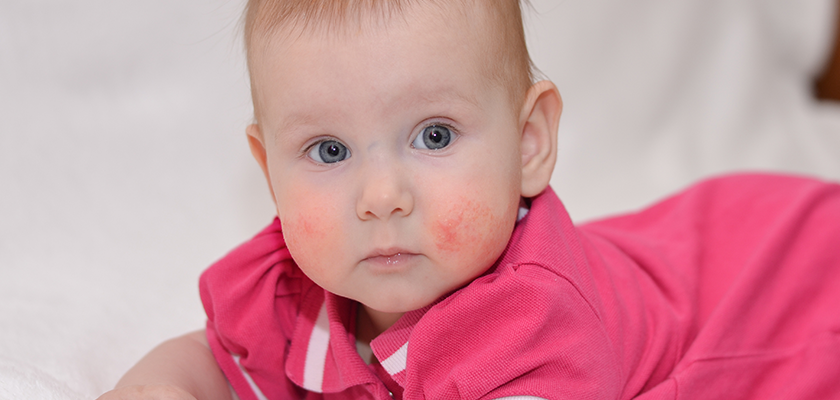 atopijski dermatitis