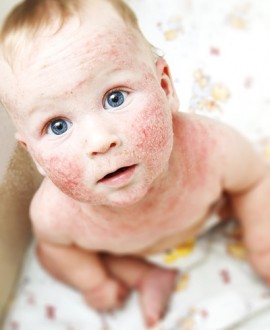 Kada koža počne da se peruta, crveni i svrbi:  Atopijski dermatitis