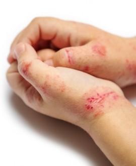 Često pranje ruku kod dece sa atopijskim dermatitisom: kako sprečiti pogoršanje ekcema?