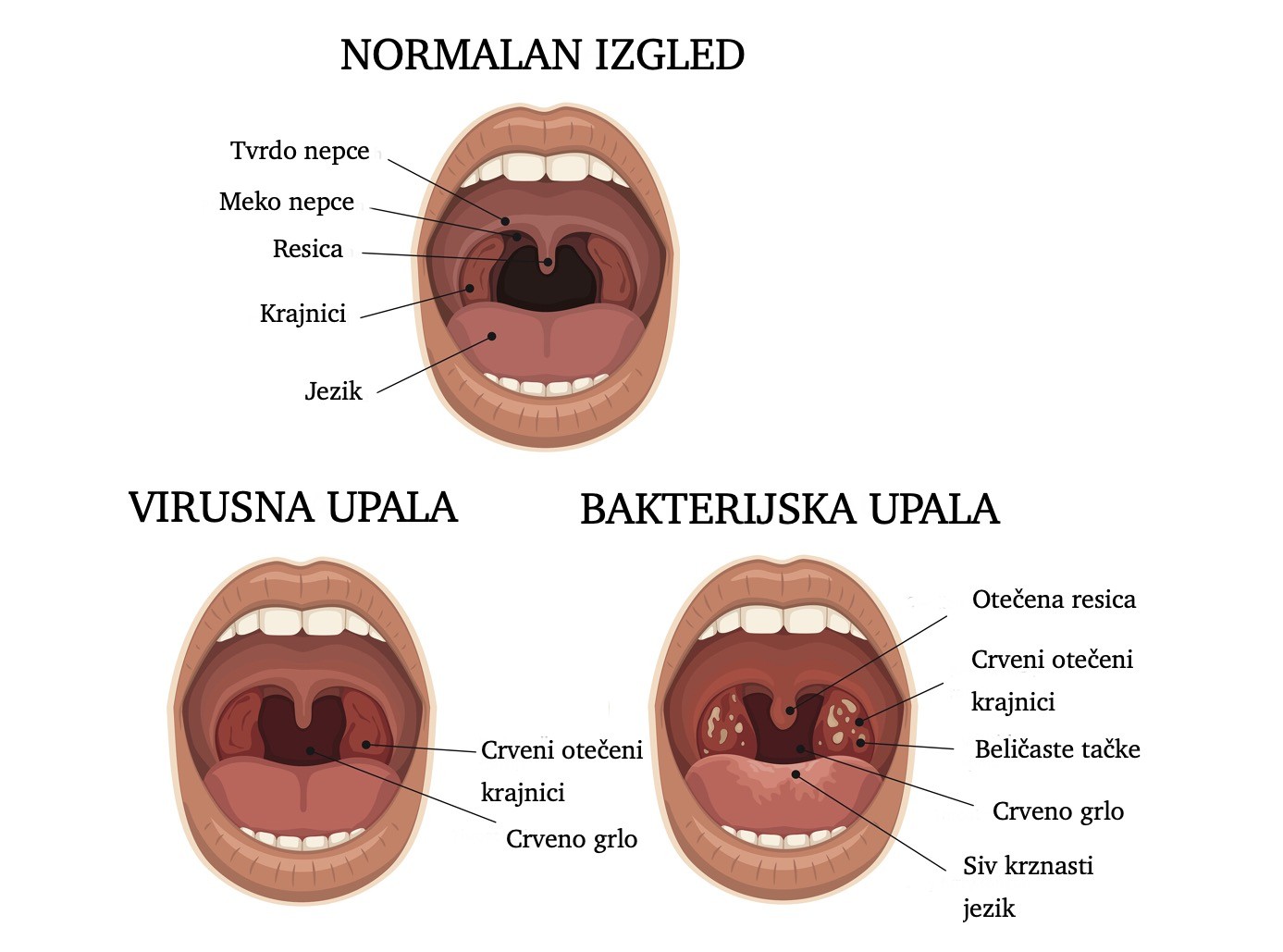 Simptomi upale grla