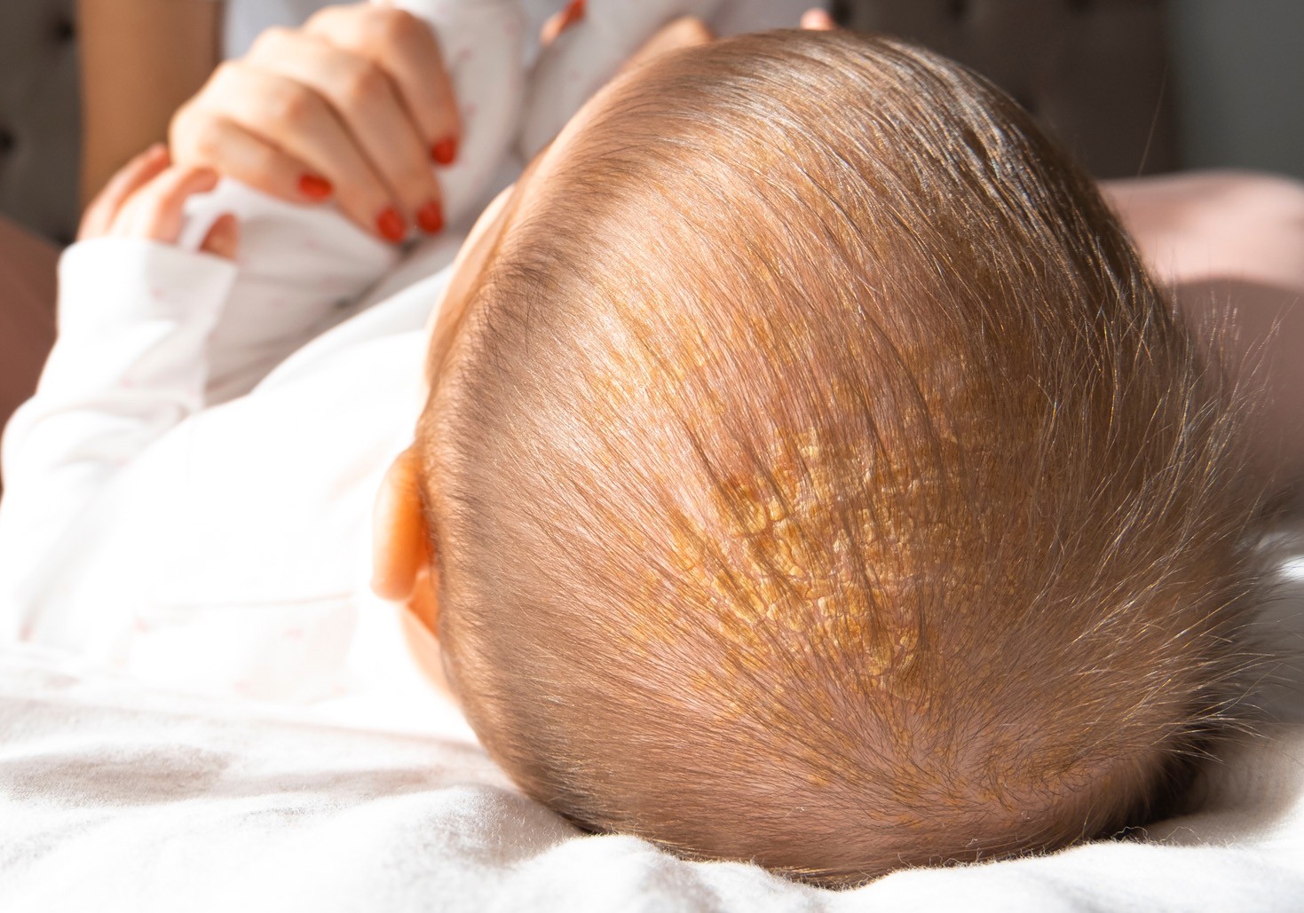 Krastaste naslage masnoće na bebinoj glavi usled temenjače. Bebu ovo stanje ne svrbi i ne boli.