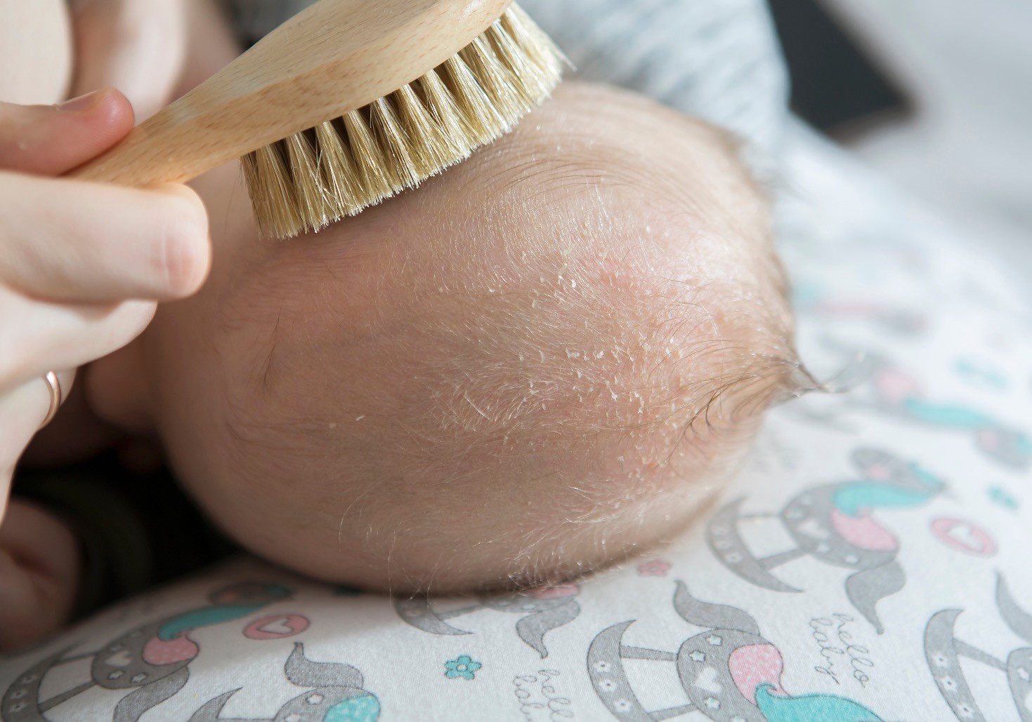 Redovno četkanje bebine glavice kao deo tretmana protiv temenjače.