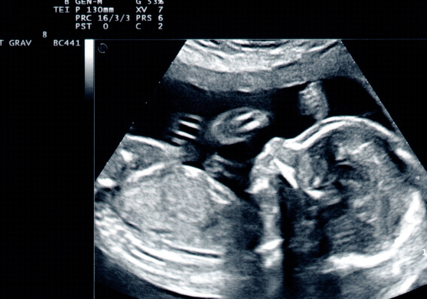 Ultrazvučni prikaz bebe u 20. nedelji trudnoće