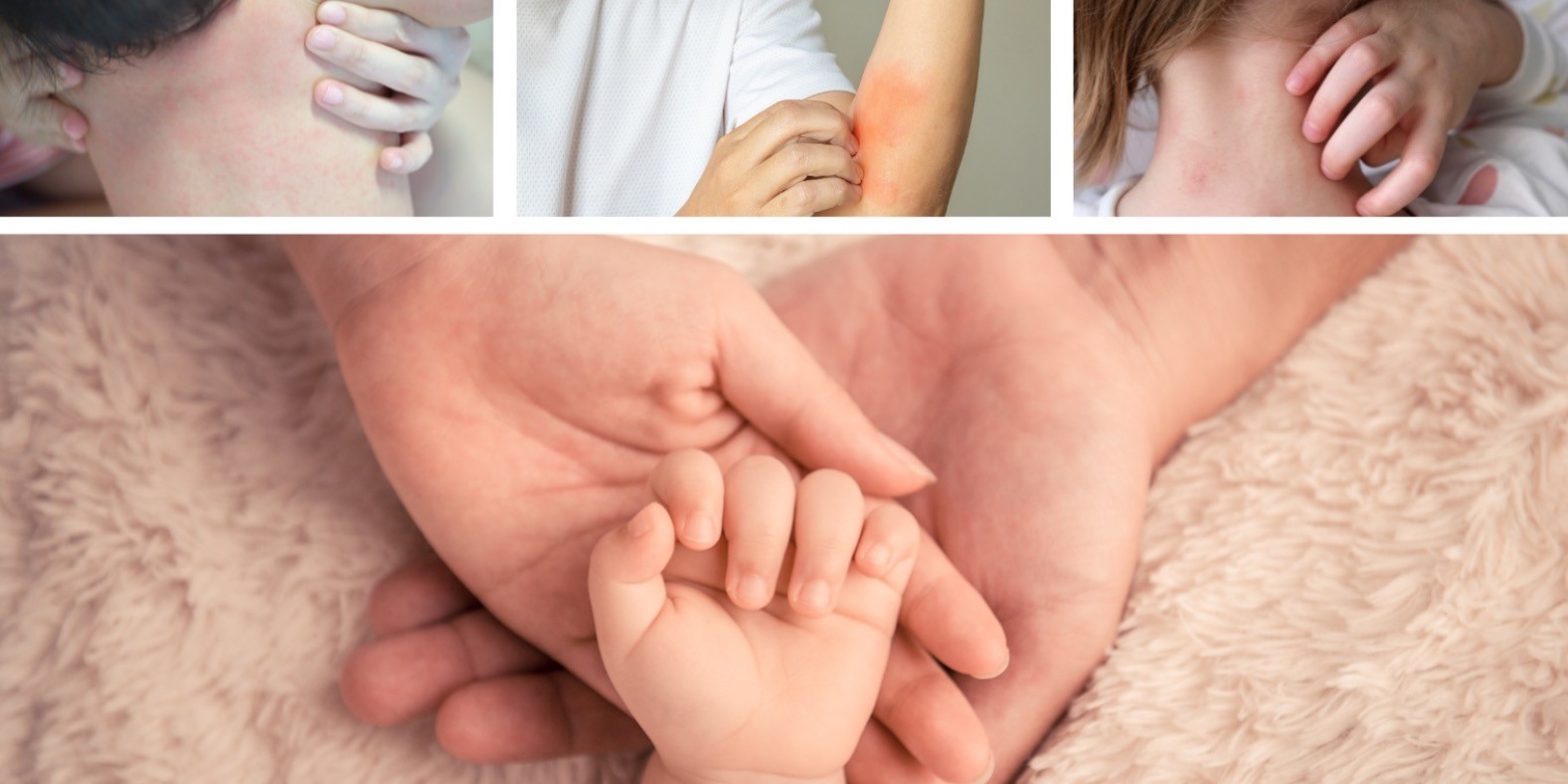 Atopijski dermatitis